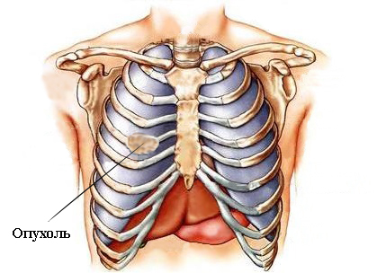 Болят ребра с двух сторон спереди и со спины