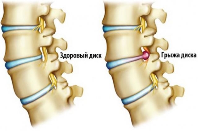 Болит очень спина больно дышать что может быть