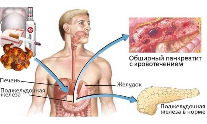 Поджелудочная железа очень остро реагирует на злоупотребления алкоголем, что может вылиться в необратимые последствия