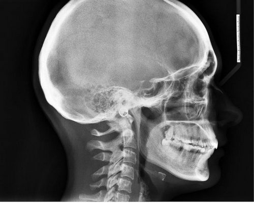 Что делать когда встаешь и болит голова