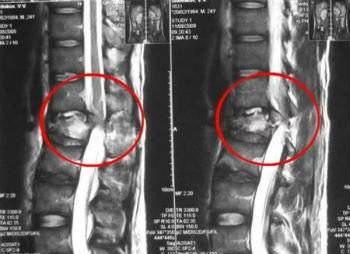При наклоне головы болит позвоночник