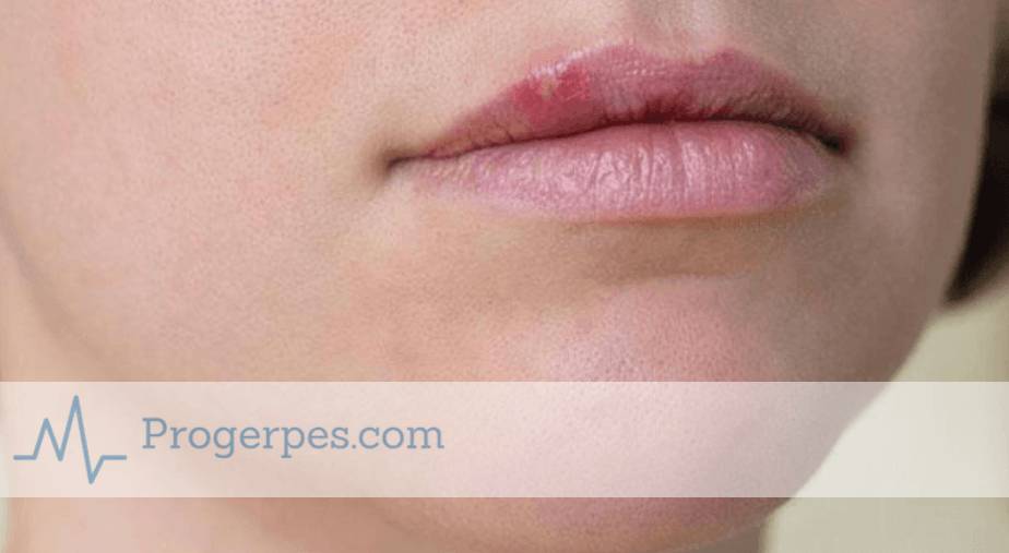 Когда заразен герпес на губах для окружающих