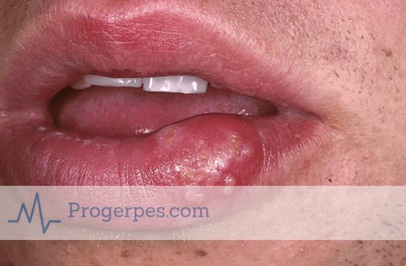 Когда заразен герпес на губах для окружающих