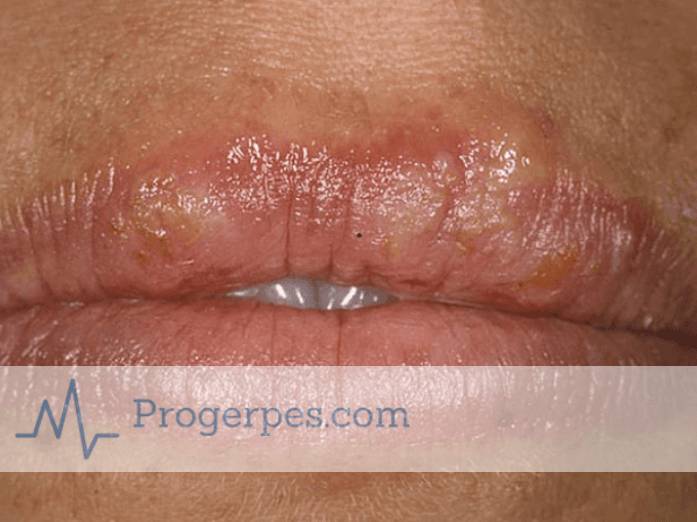 Когда заразен герпес на губах для окружающих