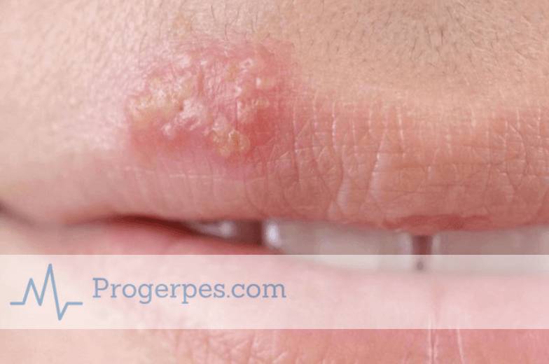 Когда заразен герпес на губах для окружающих