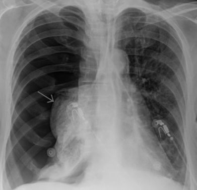 Очень болит правый бок и отдает в спину