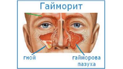 Может ли подняться температура из за болей в спине