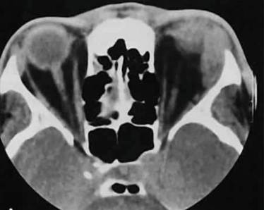 Может ли подняться температура из за болей в спине