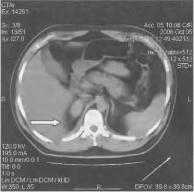 Очень болит правый бок и отдает в спину
