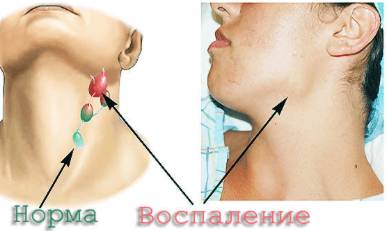 Может ли подняться температура из за болей в спине