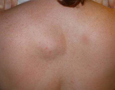 Шишка на спине под кожей болит при нажатии фото