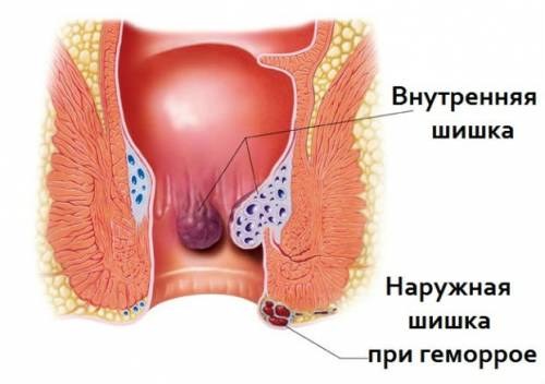 Болит спина в области копчика больно сидеть