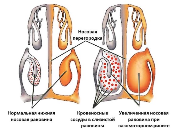 Как болит голова при вазомоторном рините