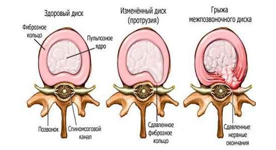 Образование грыжи позвоночника Образование грыжи позвоночника