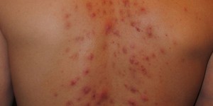Причины высыпания на спине Как избавиться от прыщей на спине