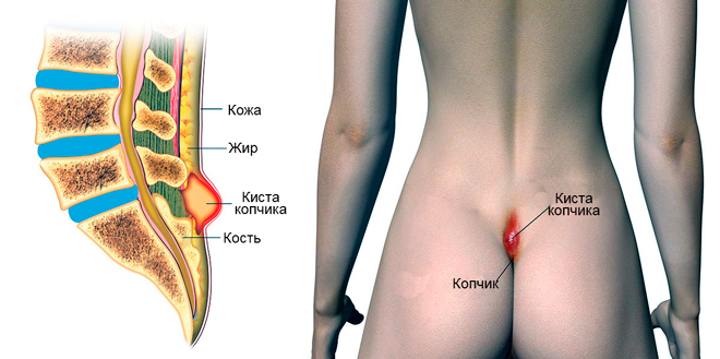 Болит спина в области копчика больно сидеть