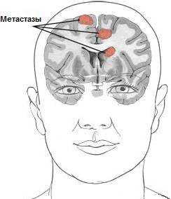 metastazy v golove