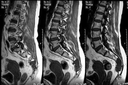 Болит спина в области копчика больно сидеть