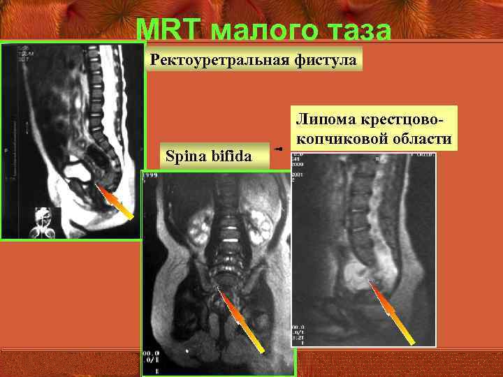 Болит спина в области копчика больно сидеть