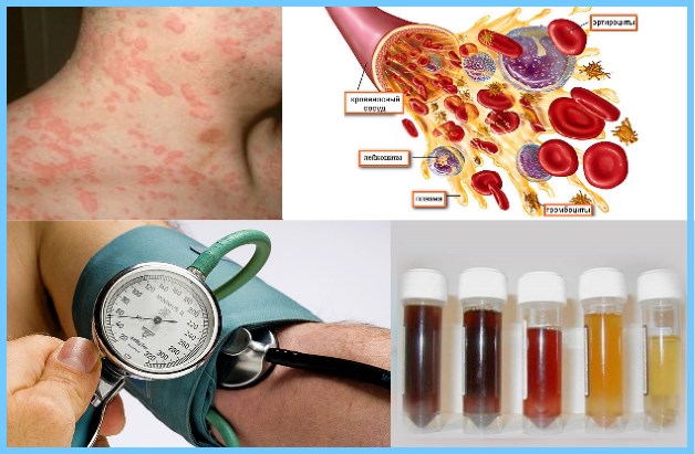 побочные эффекты анальгина