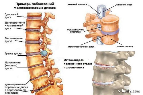 почему при приседаниях болит спина