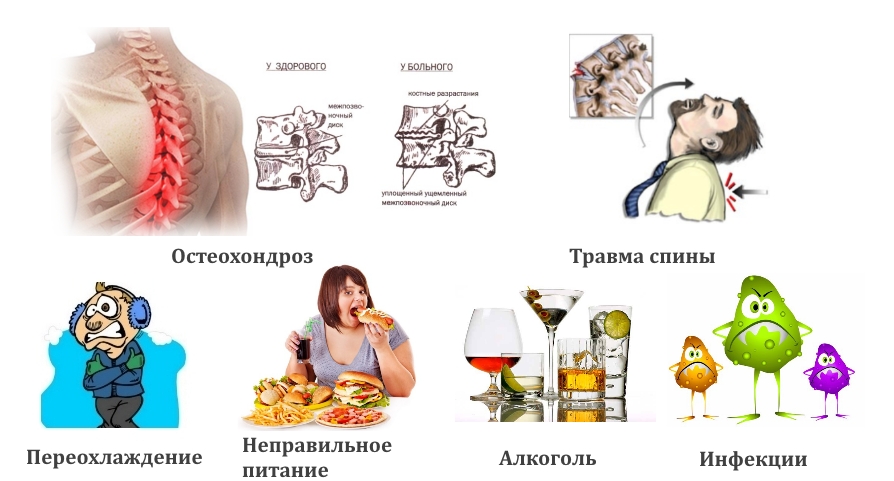 Частые причины невралгии Частые причины невралгии