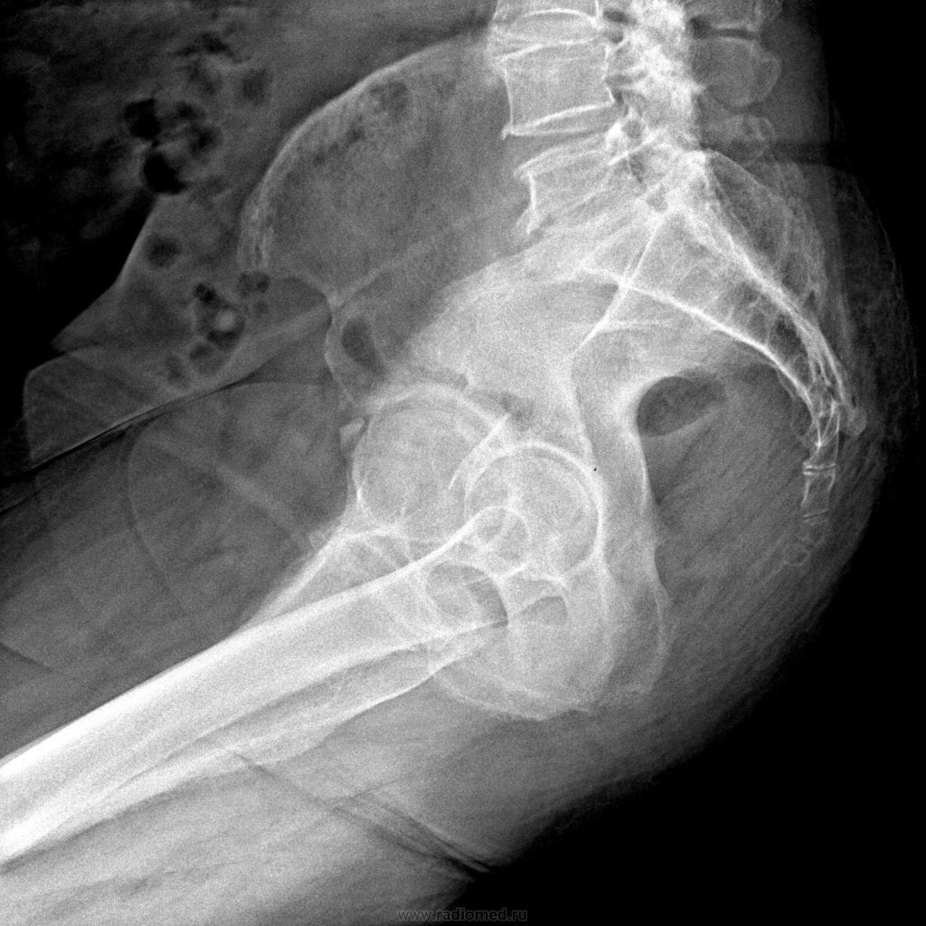 Болит спина в области копчика больно сидеть
