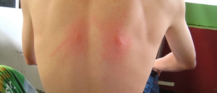 Шишка на спине под кожей болит при нажатии фото