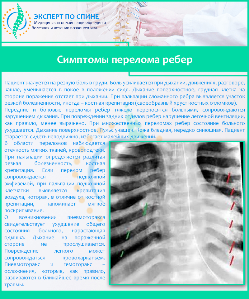 Симптомы перелома ребер