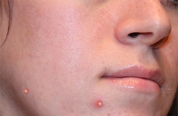 Выскочил прыщ