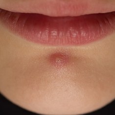 Прыщ от простуды