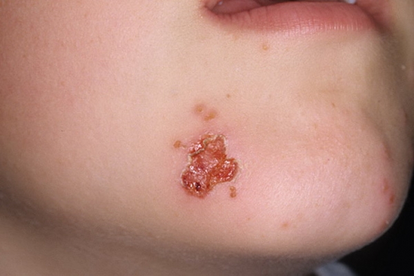 Когда герпес выскочил на подбородке